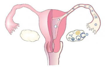 What Do Blocked Fallopian Tubes Bring To Women?