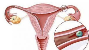 What Is Fallopian Tube Intervention And Recanalization?