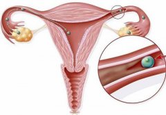 Is Conception Difficult with Fallopian Tube Blockage? How to Make a Self-Rated Check?