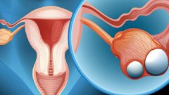 Can Fallopian Tubes be Re-blocked after Surgical Treatment?